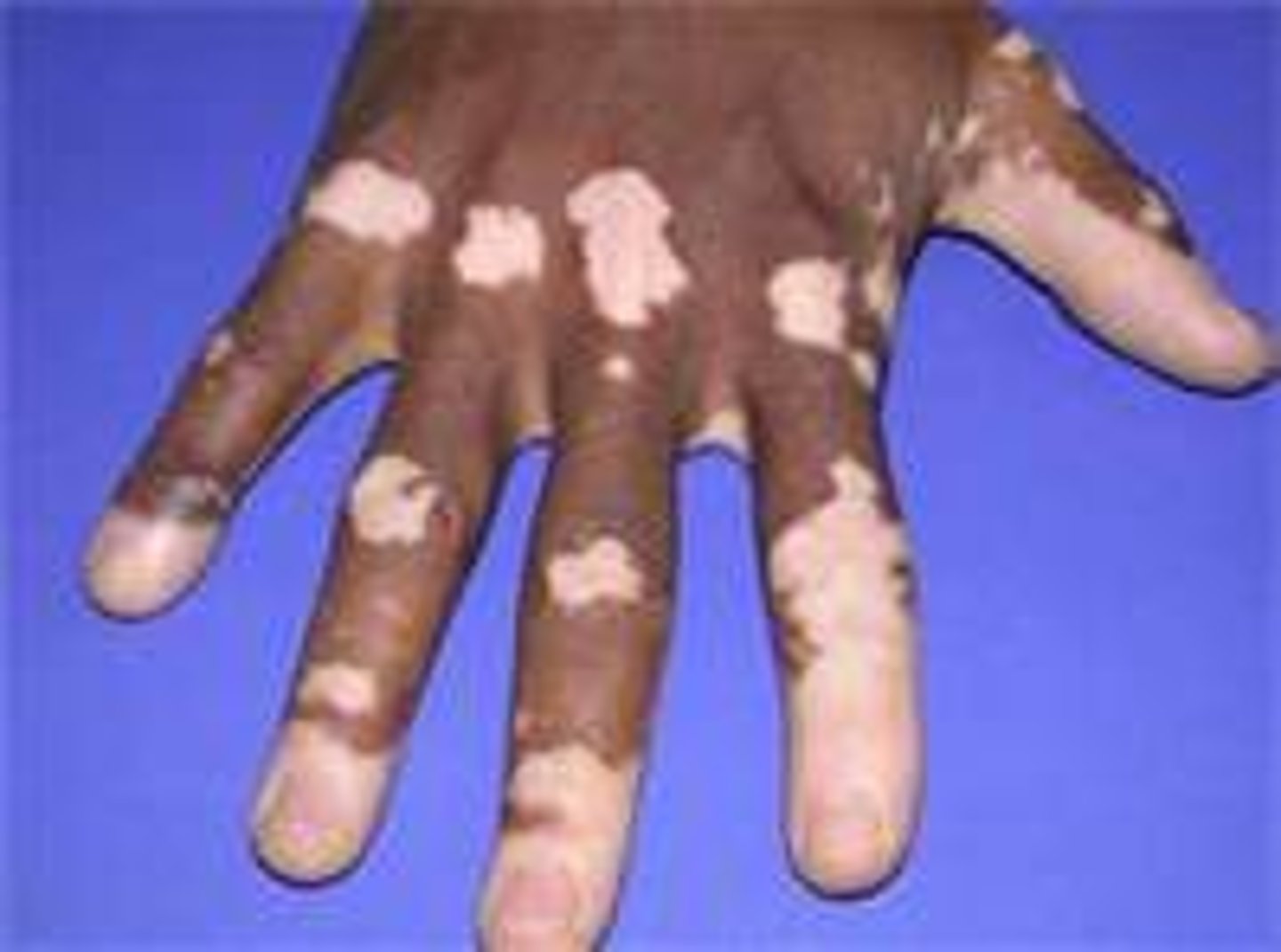 <p>localized absence of pigment; congential</p>