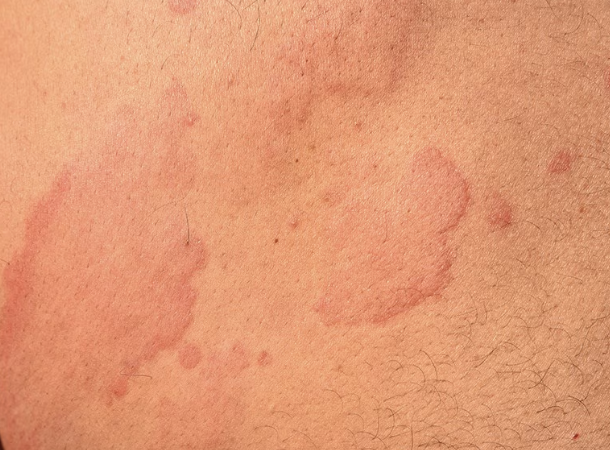 <p>what type of raised, primary skin lesion is this?</p>