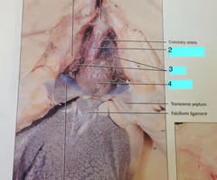 <p>sinus venosus</p>