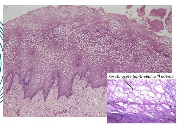 <p>-acanthosis (thickened epithelium)</p><p>-parakeratosis (thickened parakeratin specifically)</p><p>-intracellular edema in the spinous layer </p>