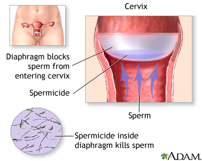 <p>a dome shaped cup with a flexible rim made of silicone that fits snugly over the cervix, effectiveness is increased with the use of a spermicidal cream or gel placed into the dome and around the rim </p>