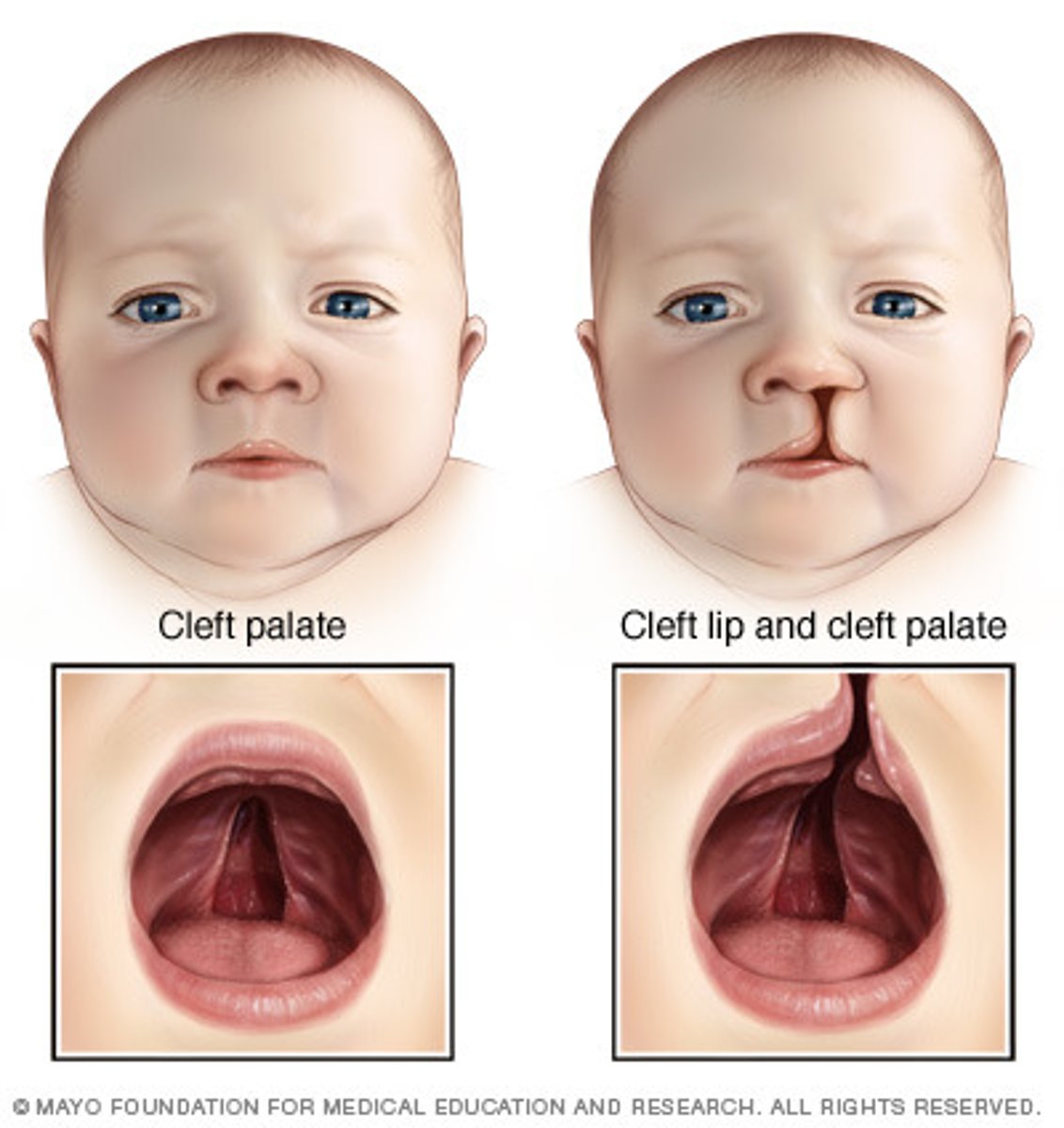 <p>happens before most women know they are even pregnant, congenital abnormality due to the failure of closure of certain facial parts during embryonic development</p>