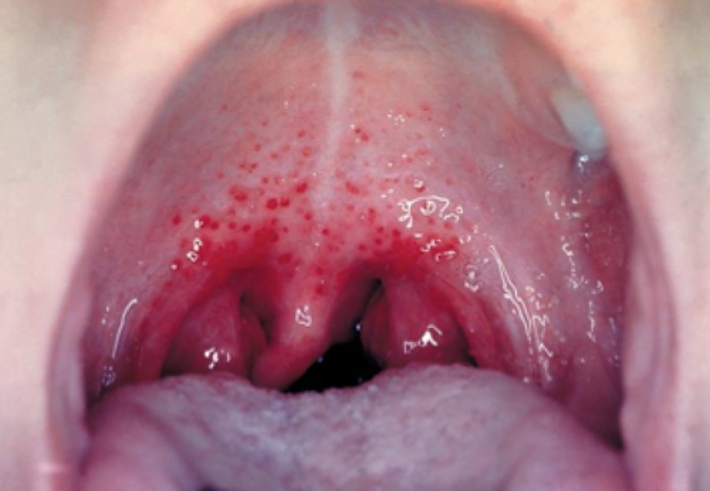 <p>tiny red dots on soft palate</p><p>• cause: trauma/leukemia</p>