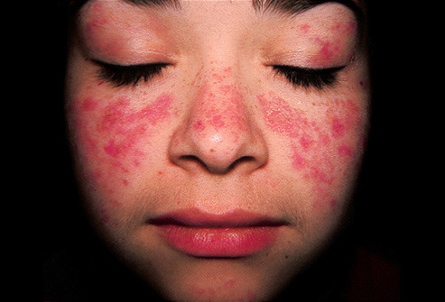 <p>Chronic autoimmune d/o w/ multisystem involvement </p><p>Young females </p><p>Butterfly rash, discoid rash, photosensitivity </p><p>+ANA in 96% </p><p>Immunosuppressive agents </p>