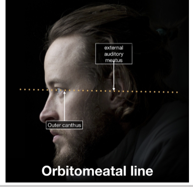 <p>Reference line from the external auditory meatus to the outer canthus of the eye, at a 10º angle in relation with the Frankfort plane.</p>