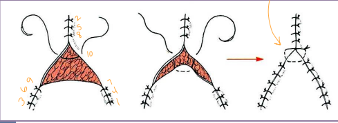<ul><li><p><strong>Dog ears</strong>: excess skin puckers</p><ul><li><p>Excise ellipse or trim excess → scissors</p></li></ul></li><li><p><strong>Circular defects</strong>: </p><ul><li><p><span style="color: rgb(136, 136, 136);"><strong>Linear:</strong></span><span style="color: red;"> </span><span style="color: red;">Start at center</span> and close parallel with line of tension</p></li><li><p><span style="color: rgb(136, 136, 136);"><strong>Ellipse: </strong></span><strong>4:1 length:width ratio</strong>, eliminates dog ears</p></li><li><p><span style="color: rgb(136, 136, 136);"><strong>Combo V:</strong> </span><span style="color: red;">45° from axis of tension</span>, extra skin is not removed → eye lid masses</p></li></ul></li><li><p><strong>Triangular defects</strong>: </p><ul><li><p><span style="color: rgb(136, 136, 136);"><strong>Y-closure:</strong> </span><span style="color: red;">Start at points</span> and work inward,<span style="color: red;"> <u>horizontal suture at center</u></span></p></li><li><p><span style="color: rgb(136, 136, 136);"><strong>Rotational flaps:</strong></span><strong> </strong>4:1 length:width ratio, semi circular flap formatted onto defect</p></li></ul></li></ul><img src="https://knowt-user-attachments.s3.amazonaws.com/72f66b48-da1f-4d77-9aee-d51926b0c38e.png" data-width="50%" data-align="center"><ul><li><p><strong>Square/rectangular</strong>: <span style="color: red;">start at corners work inward</span>, may use advancement flap</p></li><li><p><strong>Fusiform/elliptical</strong>: place central suture, bisect segments</p></li><li><p><strong>Crescentic</strong>: one side is longer than other </p><ul><li><p><span style="color: red;">close from midpoint, sutures closer on concave side</span></p></li></ul></li></ul><img src="https://knowt-user-attachments.s3.amazonaws.com/75d4db1a-c739-4a5e-a2fd-ba8bfd5cb42f.png" data-width="25%" data-align="center"><p></p>