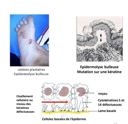 <ul><li><p><strong>Maladie associée :</strong> <strong>Épidermolyse bulleuse</strong></p><ul><li><p>Résultat de mutations sur <strong>cytokératines 5 et 14</strong></p></li><li><p><strong>Symptômes :</strong> lésions cutanées, notamment <strong>plantaires</strong></p></li><li><p><strong>Cisaillement cellulaire</strong> au niveau des cytokératines défectueuses </p></li></ul></li></ul><p></p>