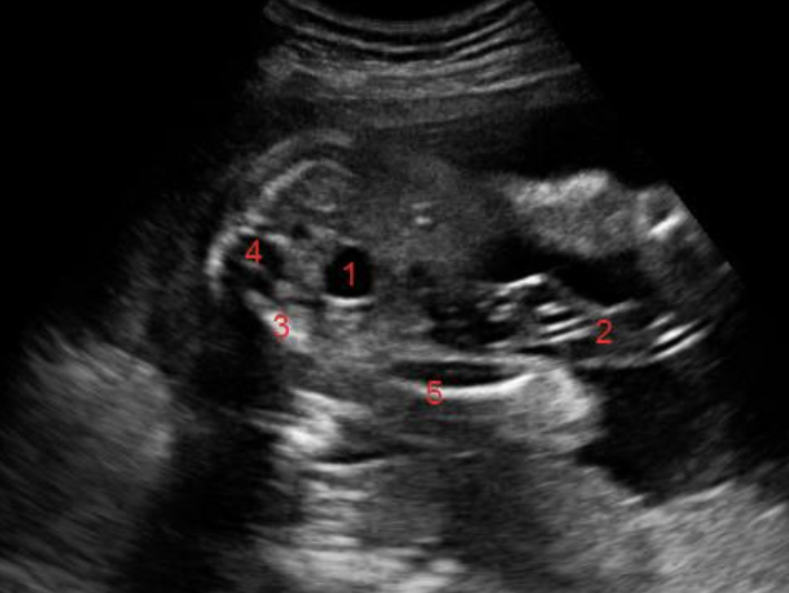 <p>what is #4</p><p>a) cord</p><p>b) sacral spine</p><p>c) lumbar spine</p><p>d) pelvic bone </p>