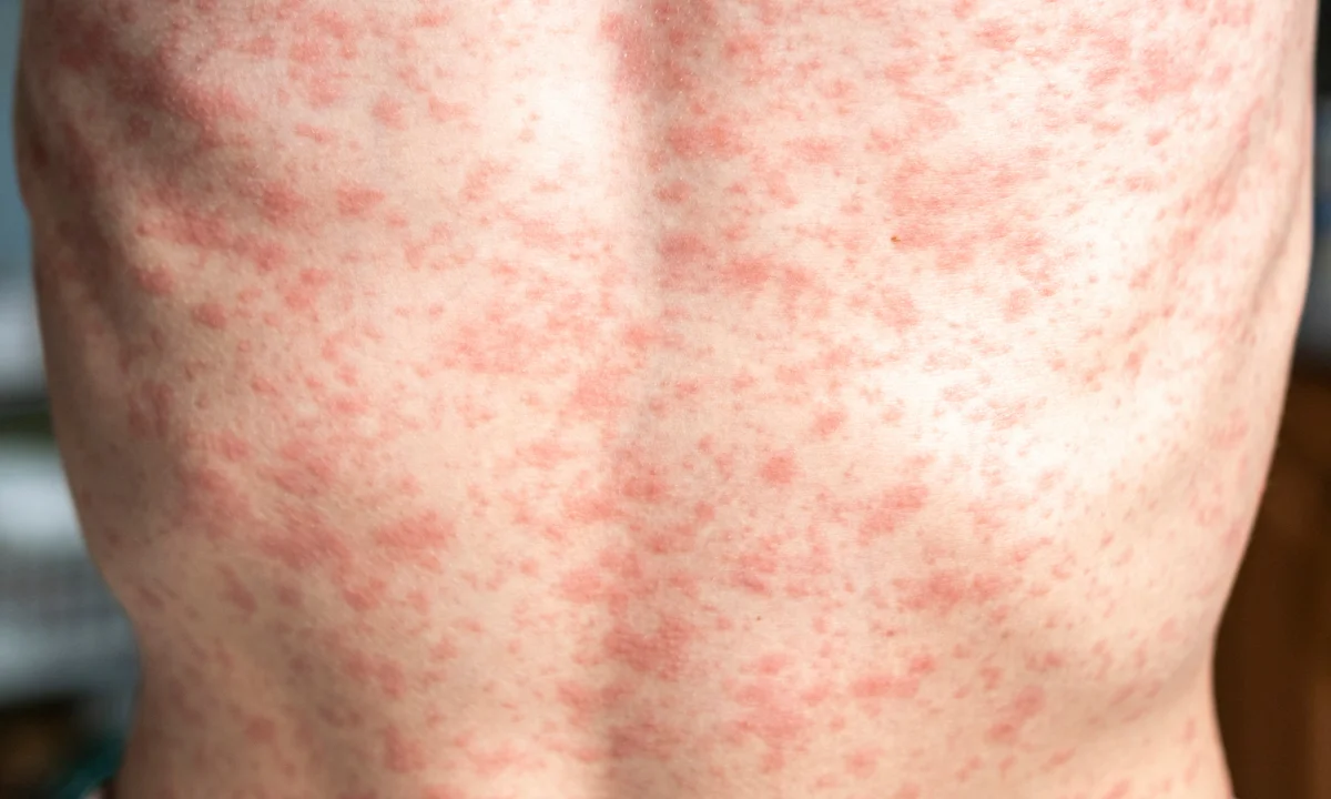 <p>measles</p>
