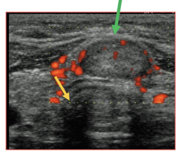 <p>What type of thyroid nodule is this - 10-15% of thyroid cancers, good prognosis BUT higher chance of spreading (bones and lungs)?</p>