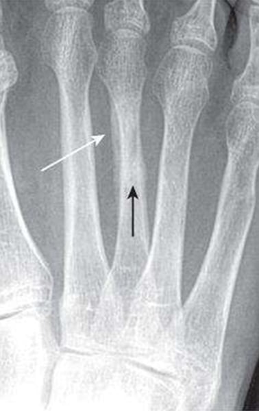 <p>What type of fracture is this?</p>