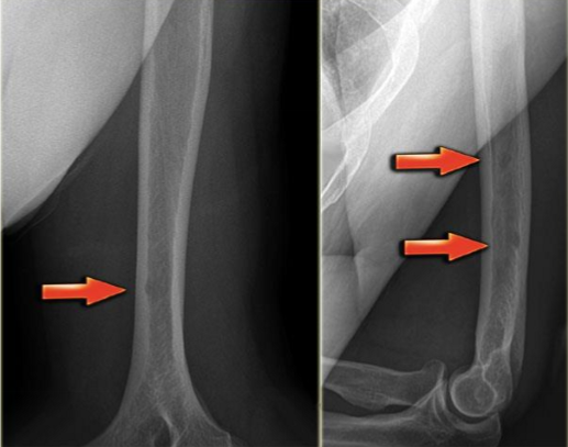 <p><span style="color: blue;"><strong><em>well defined</em></strong></span> ; from</p><ul><li><p><span style="color: green;"><strong>lung</strong></span></p></li><li><p><span style="color: green;"><strong>thyroid</strong></span></p></li><li><p><span style="color: green;"><strong>kidney</strong></span></p></li><li><p><span style="color: green;"><strong>breast</strong></span></p></li></ul><p></p>