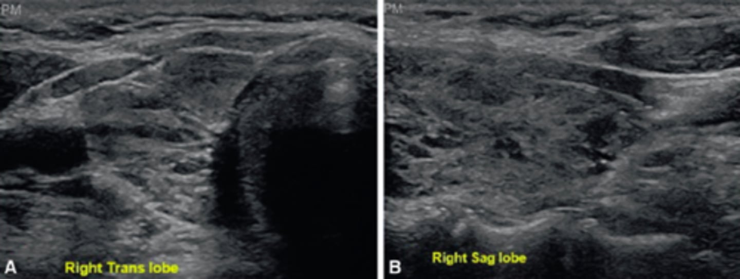 <p>d. Autoimmune lymphocytic thyroiditis</p>