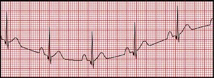 <ul><li><p>caused by movement associated with unusual breathing or poor electrode connection</p></li></ul><p></p>