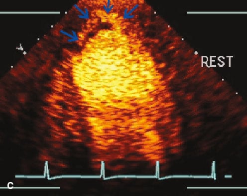 <p>Patient has h/o CAD and MI. Given bolus injection of IV contrast with very low MI imaging. What is shown at the blue arrows?</p>
