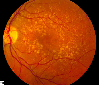 <p>PP/E: part of retina deteriorates</p><p>dry (atrophic)→gradual breakdown of cells in macula</p><p>wet (exudative/neovascular)→new abnormal blood vessels grow under central retina→leaking/bleeding/scarring</p><p>RF: age<br>family hx<br>cigarette smoking</p><p>CM: blurred/decreased central vision<br>black spot in middle of vision</p><p>PE:<br>dry→drusen in macula</p><p>wet: retinal exudates<br>neovascularization</p>