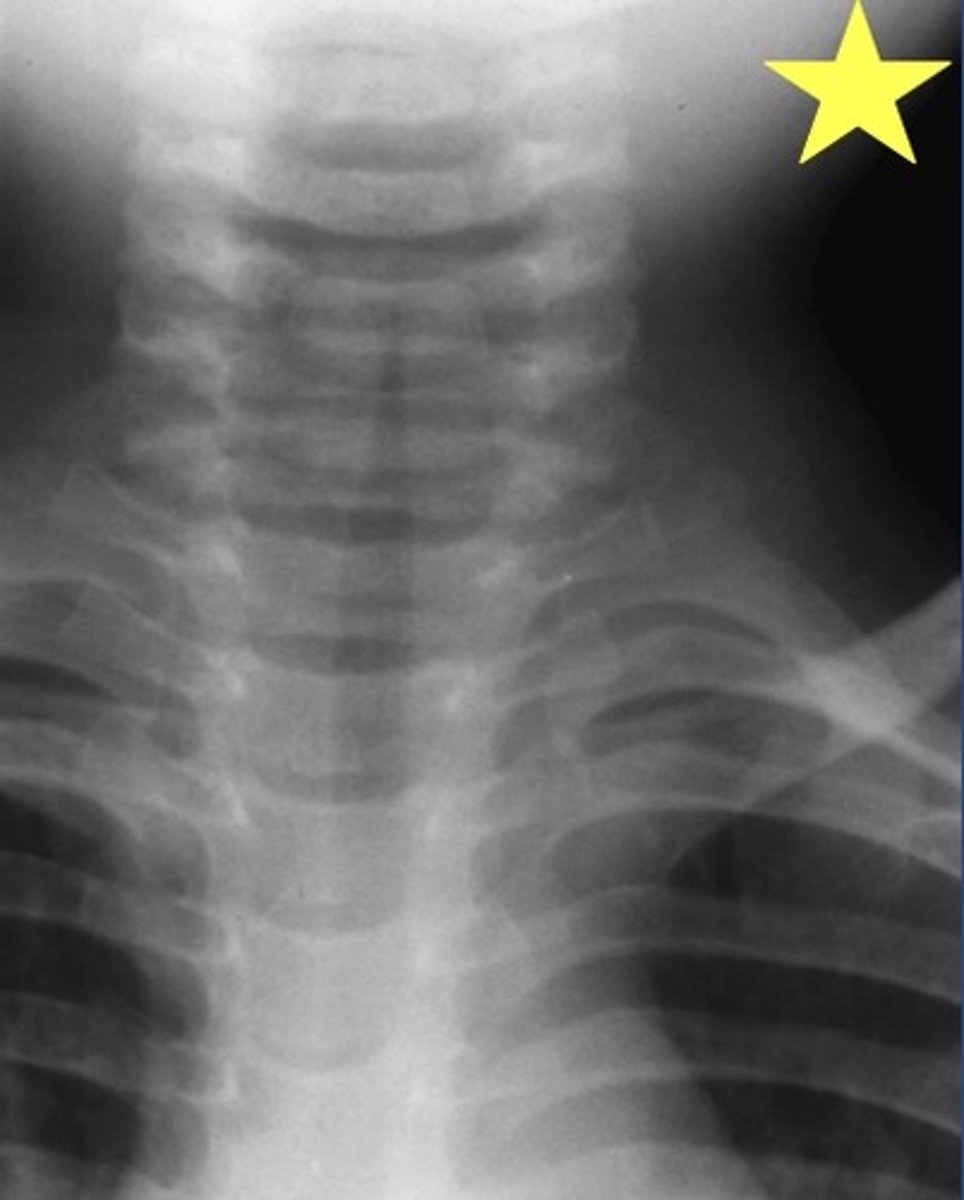 <p>Identify the radiographic abnormality. (Note the steeple sign)</p>