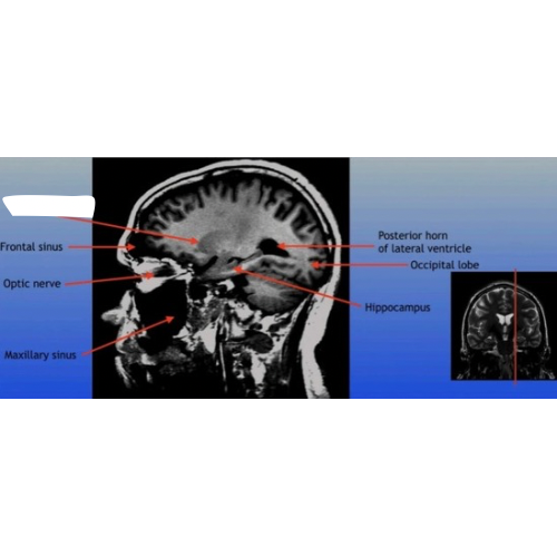 <p>A C-shaped structure within the brain's basal ganglia, involved in various functions including motor control and learning. </p>