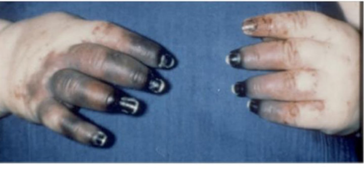<p>necrosis &amp; damage to blood vessels</p><p>*can happen due to meningitis from N. menin infection</p>