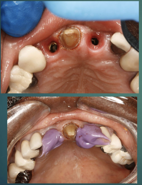 <p>inject regisil after removal of provisional restoration(s) to prevent soft tissue from collapsing </p>