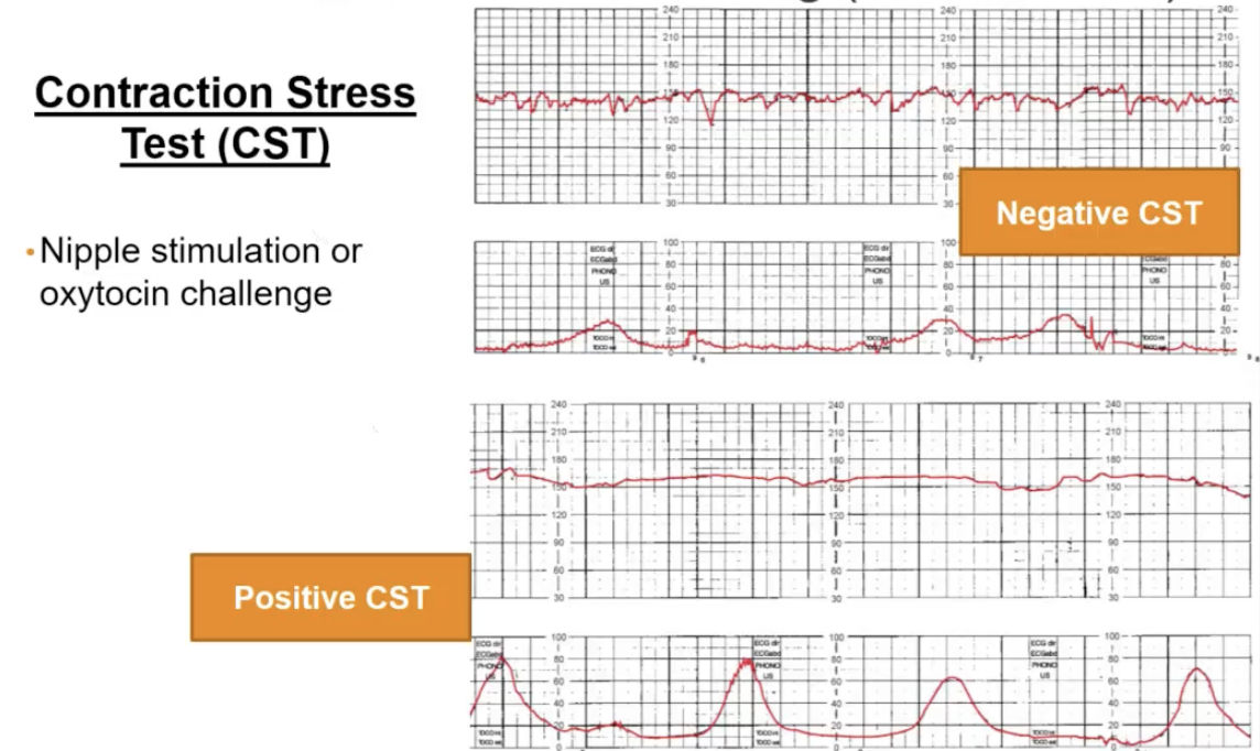 <p>Ordered to see if the baby can have contractions and be delivered vaginally</p><p>Negative = Good ; Positive = Bad</p>