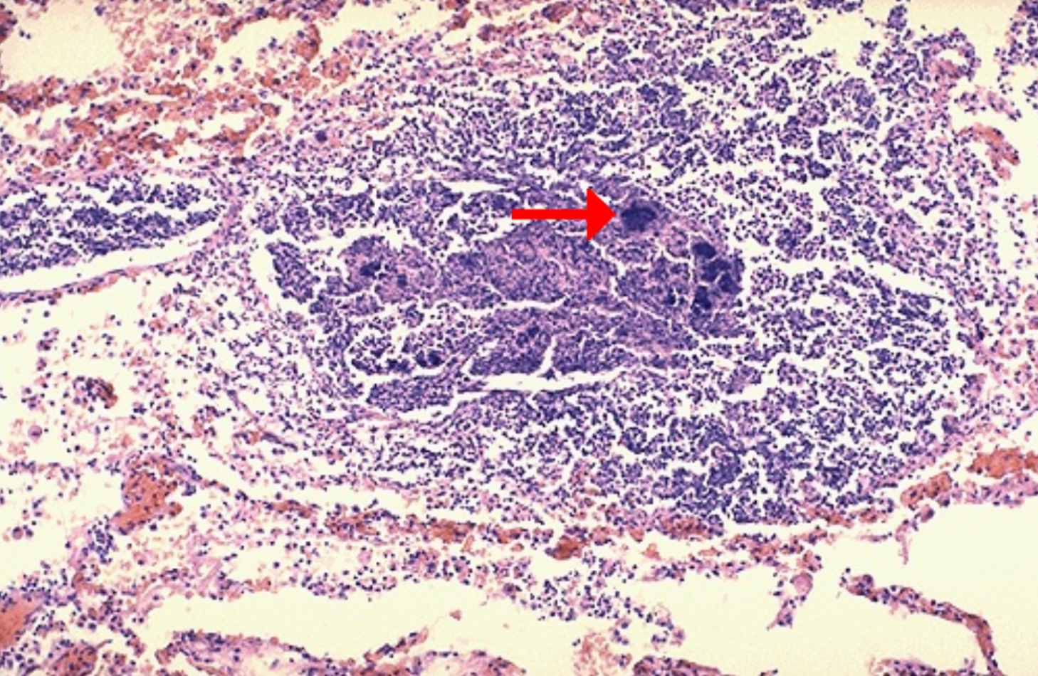 <ol><li><p>Abscess</p></li><li><p><span>Fuzzy dark purple areas represent </span>clusters of bacterial colonies</p></li></ol><p></p><p><span>The alveoli in that area have been destroyed.</span></p><p></p>