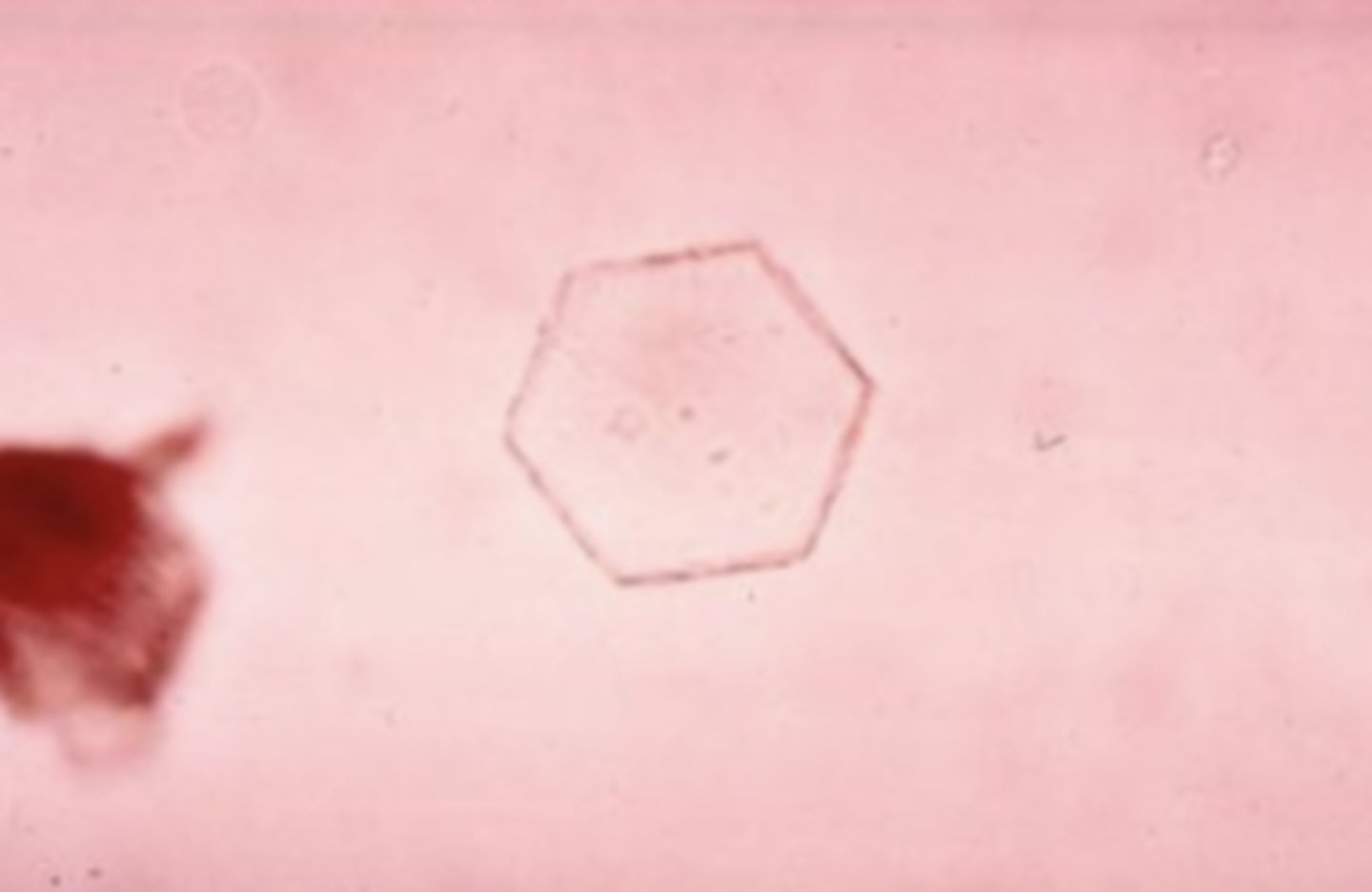 <p>an abnormality in the metabolism of the amino acid cysteine. These crystals appear as colorless, refractile, hexagonal plates with even sides.</p>