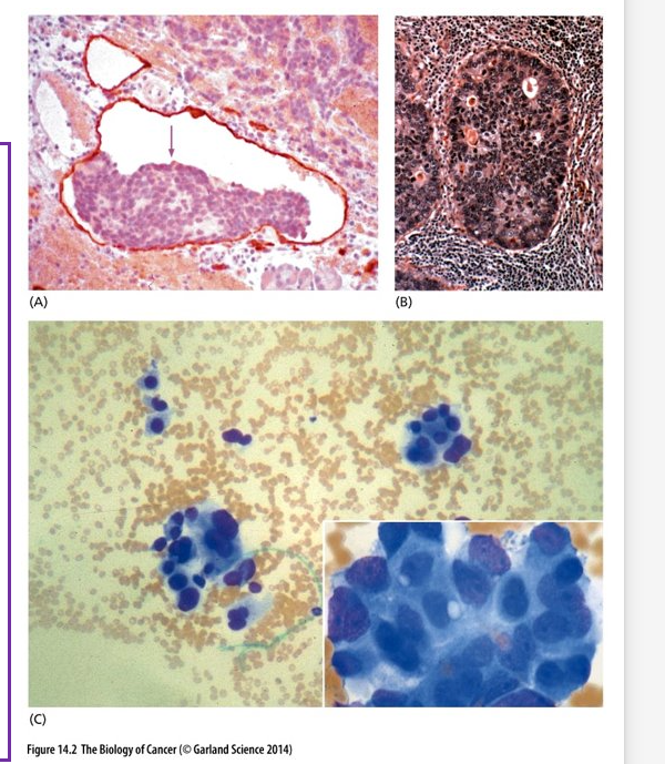 <ul><li><p class="Paragraph WhiteSpaceCollapse SCXP2864781 BCX0" style="text-align: left"><span>(A) Pancreatic Islet cell metastases in a lymphatic vessel (outlined in red)​</span></p></li><li><p class="Paragraph WhiteSpaceCollapse SCXP2864781 BCX0" style="text-align: left"><span>(B) Breast cancer growing within a lymph node​</span></p></li><li><p class="Paragraph WhiteSpaceCollapse SCXP2864781 BCX0" style="text-align: left"><span>(C) Clumps of carcinoma cells in the bone marrow​</span></p></li><li><p class="Paragraph WhiteSpaceCollapse SCXP2864781 BCX0" style="text-align: left"><span>Certain cancers take on specific metastatic paths​</span></p></li><li><p class="Paragraph WhiteSpaceCollapse SCXP2864781 BCX0" style="text-align: left"><span>Breast Cancers – brain, liver, bones, lungs​</span></p></li><li><p class="Paragraph WhiteSpaceCollapse SCXP2864781 BCX0" style="text-align: left"><span>Prostate Cancer – Bones​</span></p></li><li><p class="Paragraph WhiteSpaceCollapse SCXP2864781 BCX0" style="text-align: left"><span>Colon Cancer – Liver​</span></p></li><li><p class="Paragraph WhiteSpaceCollapse SCXP2864781 BCX0" style="text-align: left"><span>Tumors of certain tissues have a high probability of metastasizing and some never metastasize​</span></p></li><li><p class="Paragraph WhiteSpaceCollapse SCXP2864781 BCX0" style="text-align: left"><span>Primary melanomas of the skin almost always metastasize​</span></p></li><li><p class="Paragraph WhiteSpaceCollapse SCXP2864781 BCX0" style="text-align: left"><span>Basal cell carcinomas rarely metastasize​</span></p></li><li><p class="Paragraph WhiteSpaceCollapse SCXP2864781 BCX0" style="text-align: left"><span>We still do not fully understand the mechanisms underlying invasion and metastasis</span></p></li></ul><p></p>