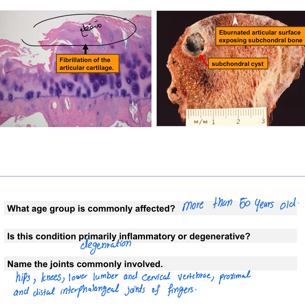 <p><span><strong>Osteoarthritis (OA)</strong></span></p>