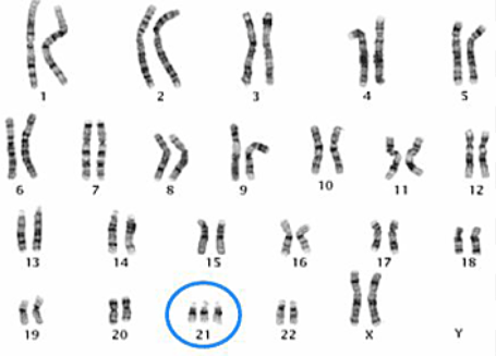<p>when homologous chromosomes in meiosis I or sister chromatids in meiosis II separate incorrectly and the resulting gametes are not haploid</p><p>the gametes may carry an extra chromosome(n+1) r lack one altogether(n-1)</p><p>ex. down syndrome, 3 copies of chromosomes 21</p>