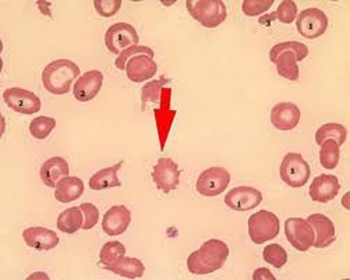 <p>Spiculated RBC with numerous short, evenly spaced, blunt to sharp surface projections of uniform shape and size. Seen in dogs with lymphosarcoma, after exercise in horses, and in healthy pigs. Also occur after snake bites in dogs or because of prolonged sample storage</p>