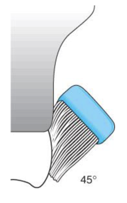 <ul><li><p>brush bristles placed parallel long axis of the tooth </p></li><li><p>bristles points incisally </p></li><li><p>pressed into margin/proximal area and vibrated </p></li></ul><p></p>