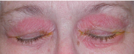 <ol><li><p>contact dermatitis </p></li><li><p>superinfectin if with ohter wide spectrum drugs </p></li><li><p>no systemic abs w topical use </p></li></ol><p></p>