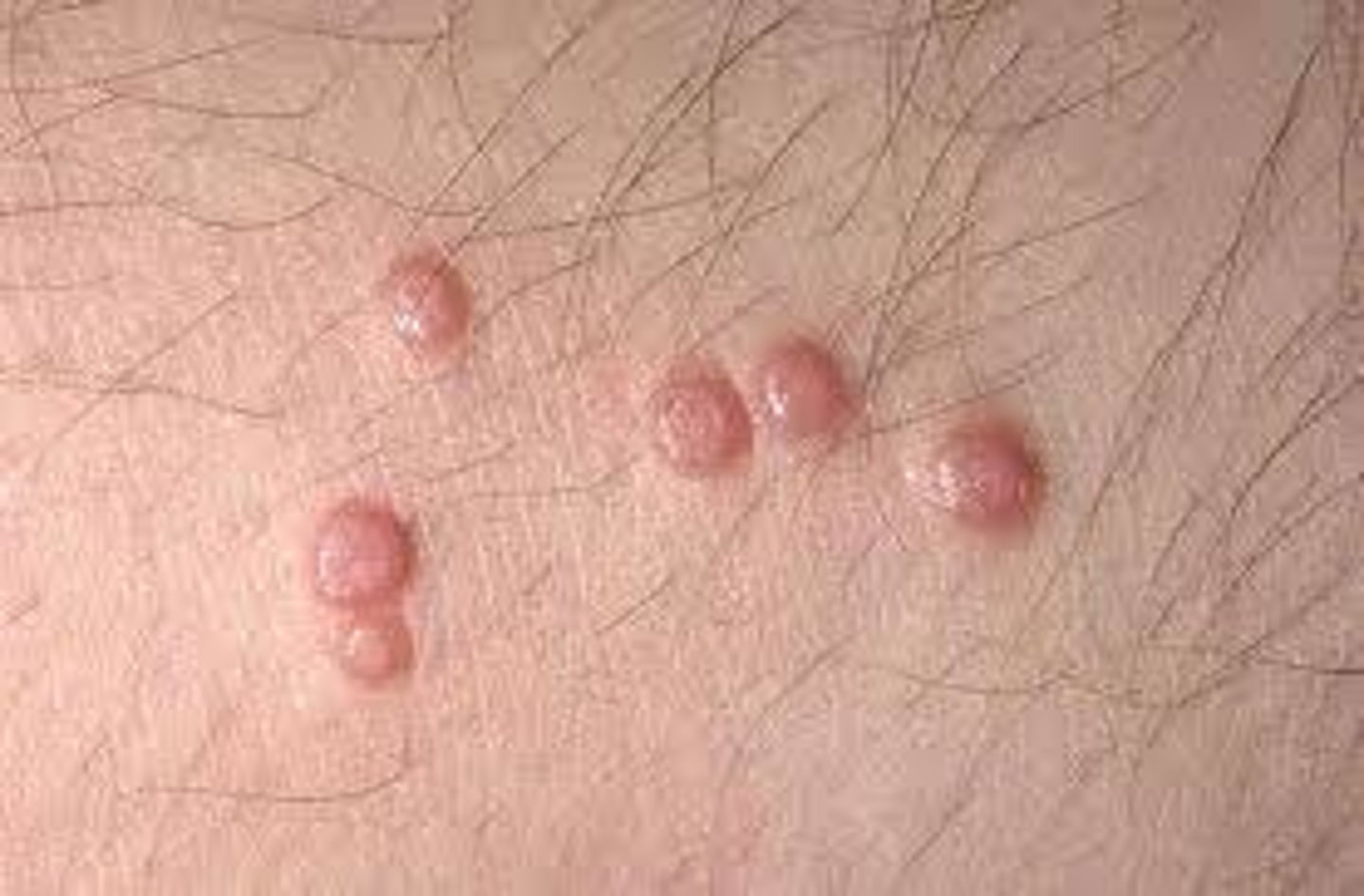 <p>treatment for which benign epithelial lesion:</p><p>• Spontaneous remission in 6-9</p><p>months</p><p>• Recurrence in ⅓</p><p>• Curettage or cryotherapy</p>