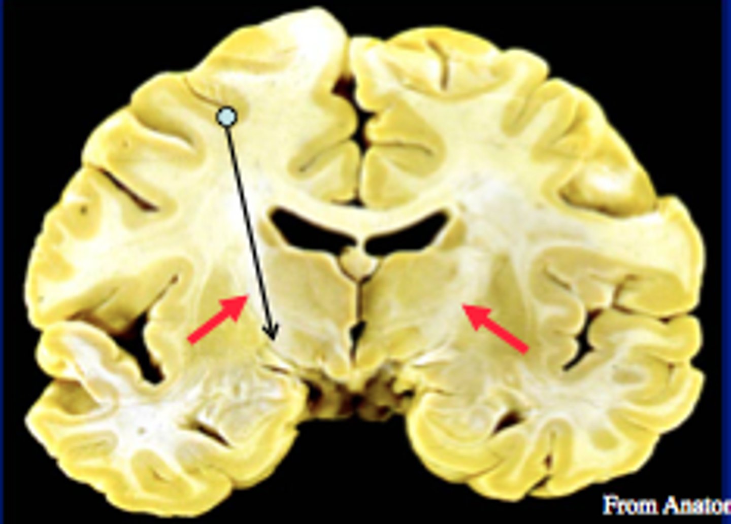 <p>A large collection of axons that connects the telencephalon with the diencephalon</p><p>Pyramidal tracts, among other things, pass through here</p>
