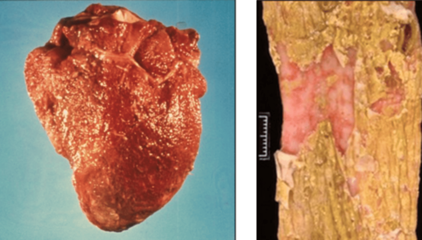 <p>what type of exudate is depicted in the image?</p>
