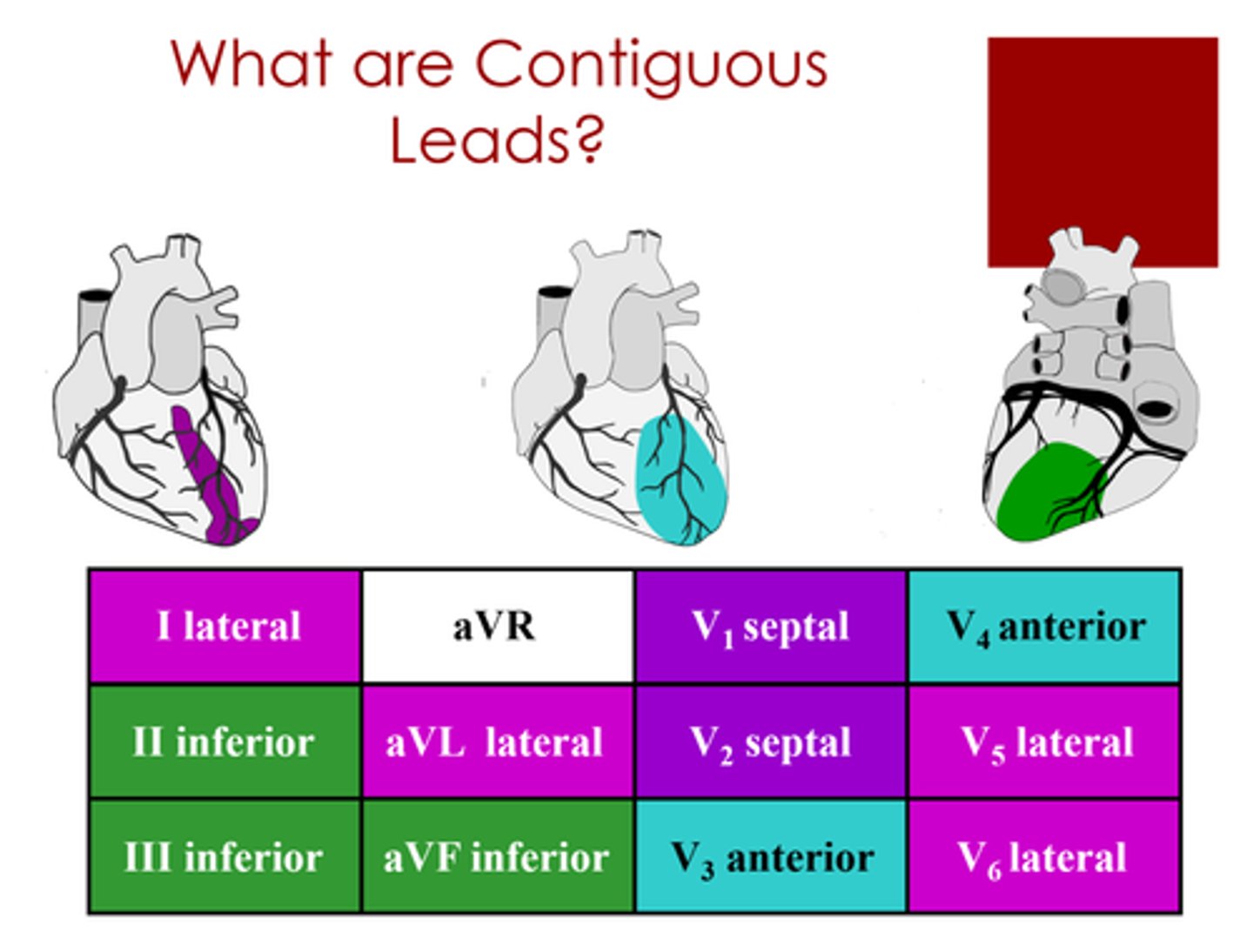 <p>I, aVL, V5, V6</p><p>left circumflex or diagonal of LAD</p>