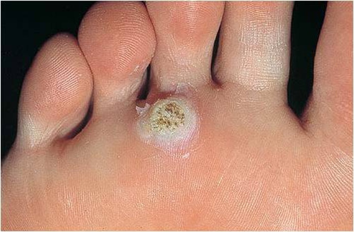 <p>type of plantar wart characterized by a deeper, endophytic growth pattern and are often associated with HPV type 1, showing a distinct histological appearance with keratohyalin inclusions</p>