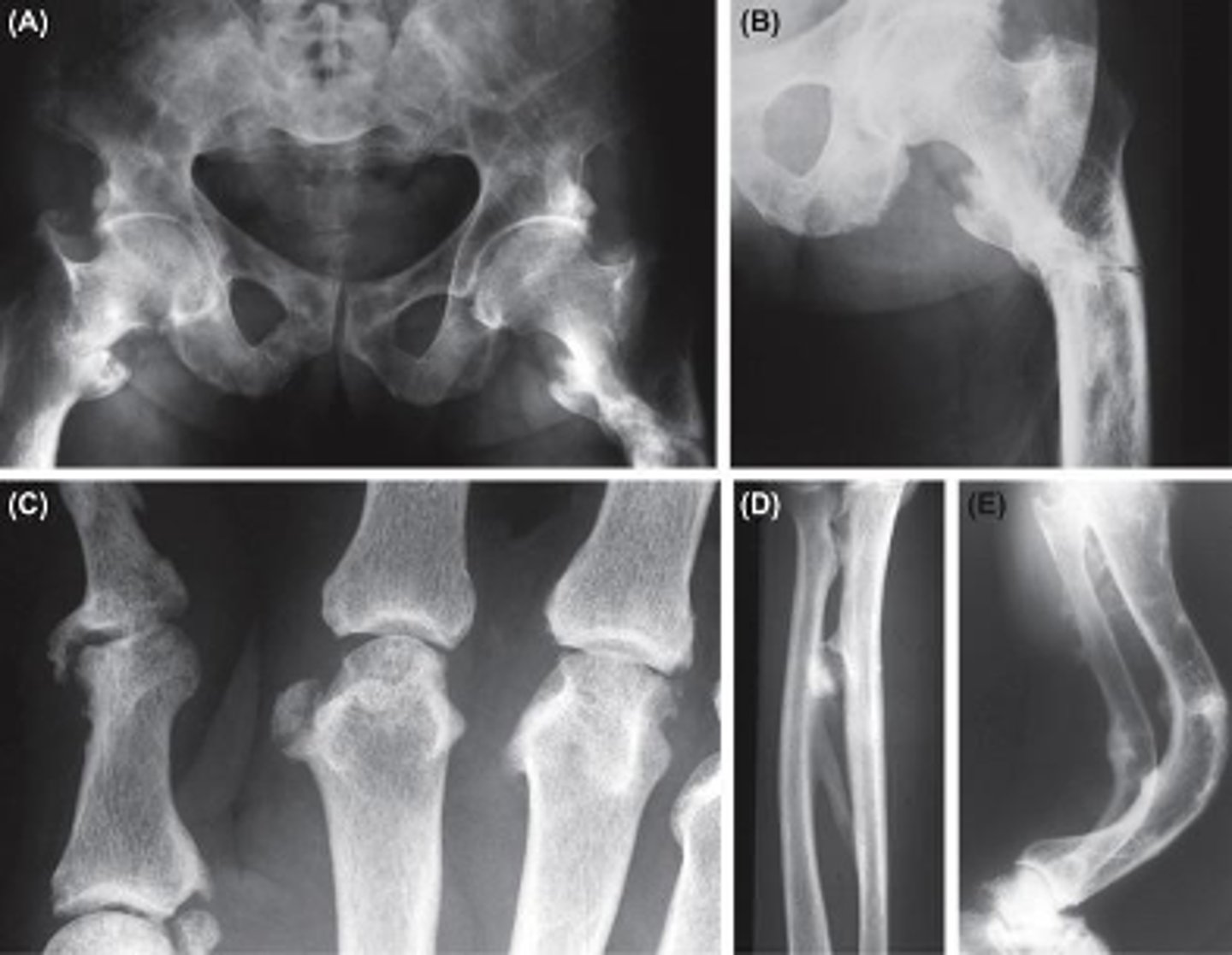 <p>deficiency in this vitamin is associated with Osteomalacia in adults, leading to:</p><p>•Diffuse skeletal pain</p><p>•Susceptible to fracture</p>