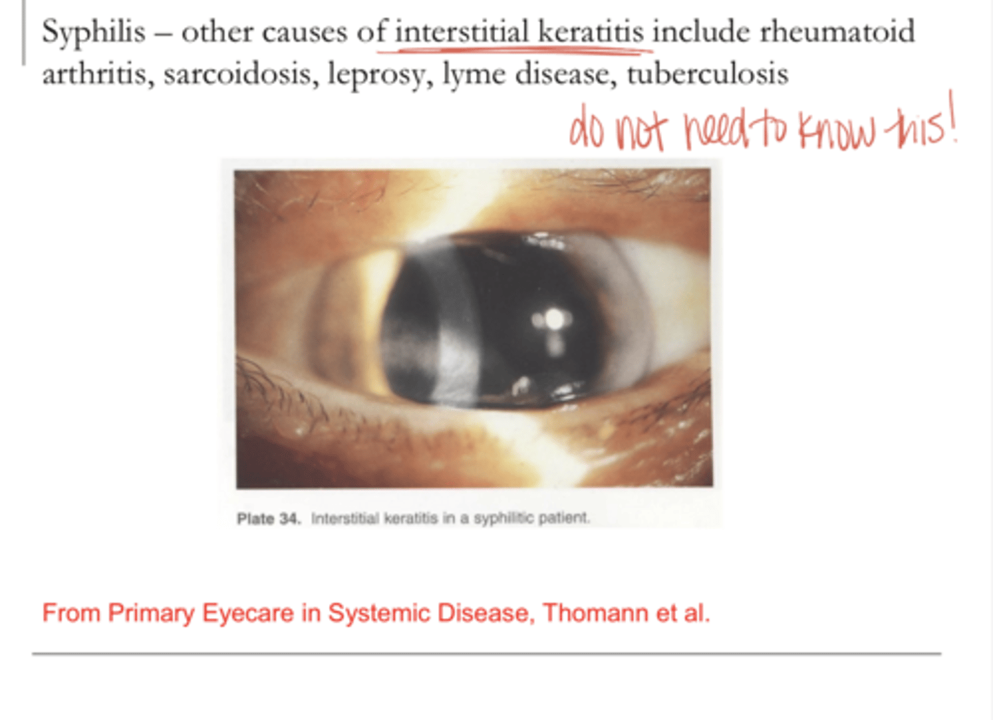<p>Syphilis -- Interstitial Keratitis (Pic)</p>