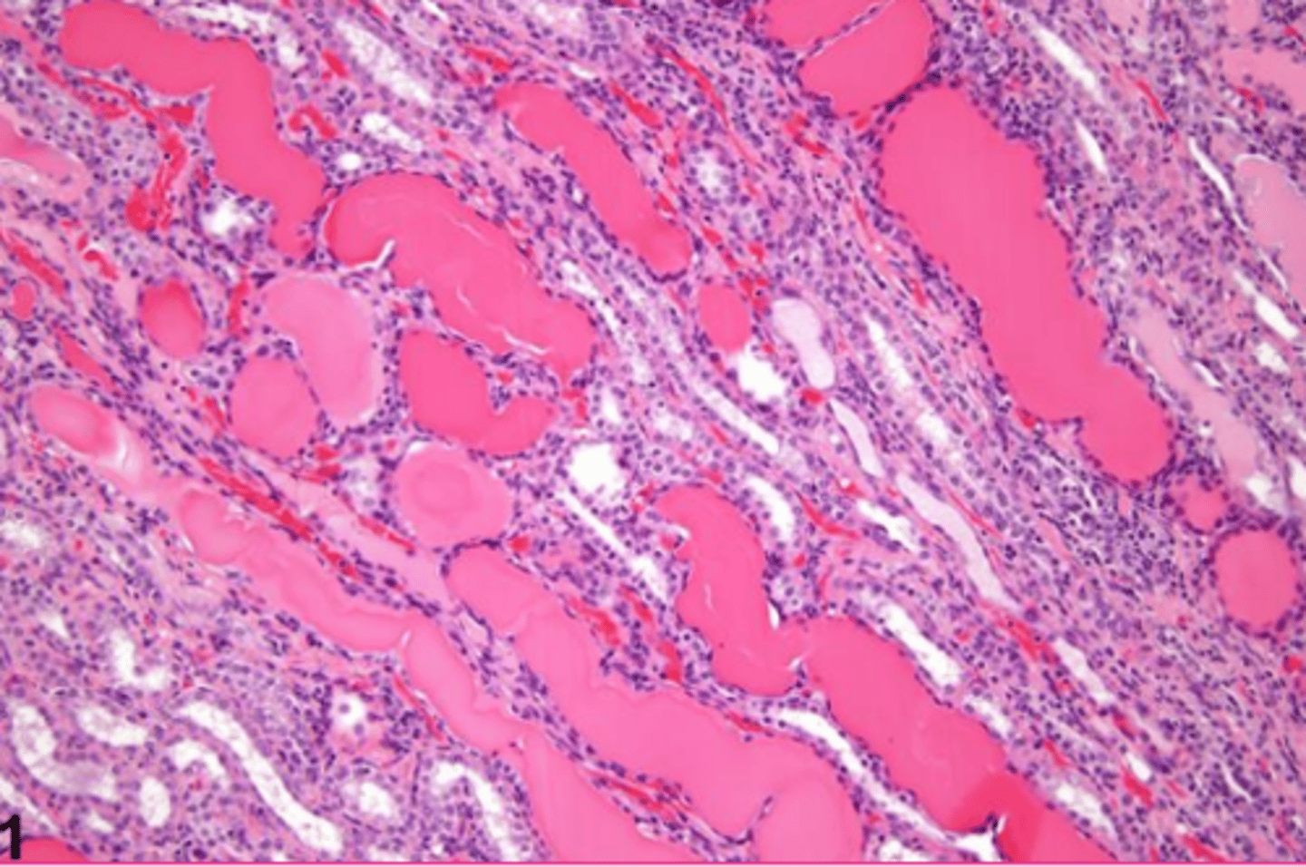 <p>What extracellular accumulation?</p>