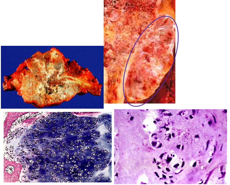 <p>second most common <strong><span style="color: red">malignant matrix-producing tumor</span></strong><span style="color: red"> </span>of bone that <strong>commonly arise in the <span style="color: red">central (intramedullary) portions of the axial skeleton, including the pelvis, shoulder &amp; ribs</span></strong></p><ul><li><p>15% may arise from enchondroma or osteochondroma (secondary type)</p></li></ul><p>clinical presentations</p><ul><li><p>occurs in <strong><mark data-color="green">males age 40 years or older</mark></strong></p></li><li><p><strong><mark data-color="blue">large, bulky tumors made up of nodules of gray-while, somewhat translucent glistening tissue</mark></strong></p></li><li><p>tumor cells: <strong><mark data-color="blue">vary in degree of cellularity, cytologic atypia, &amp; mitotic activity</mark></strong></p></li></ul><p>treatment</p><ul><li><p><strong><mark data-color="purple">wide surgical excision</mark></strong></p></li><li><p>5-year survival rate: <strong><mark data-color="purple">grade 1 tumors (80 - 90%) vs grade 3 tumors (43%)</mark></strong></p><ul><li><p><strong><span style="color: purple">grade > stage</span></strong></p></li></ul></li></ul>