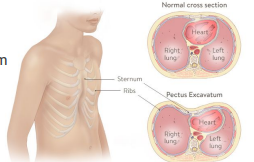 <p>Creates a protrusion inwards </p>