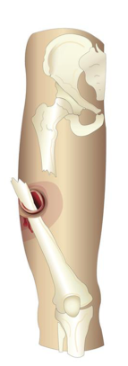 <p>what type of fracture is this?</p>