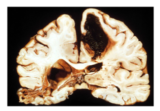 <p>What type of brain lesion is this?</p>