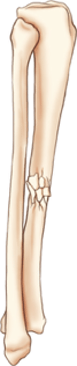 <p>Two or more fragments</p><p>Examples:</p><p>- Segmental fracture (double-type fracture)</p><p>- Butterfly fracture (two fragments)</p><p>- Splintered fracture (thin, sharp fragments)</p>