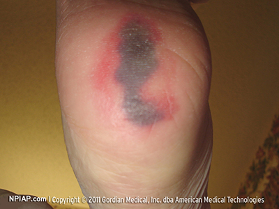 <p>Deep tissue pressure injury </p>