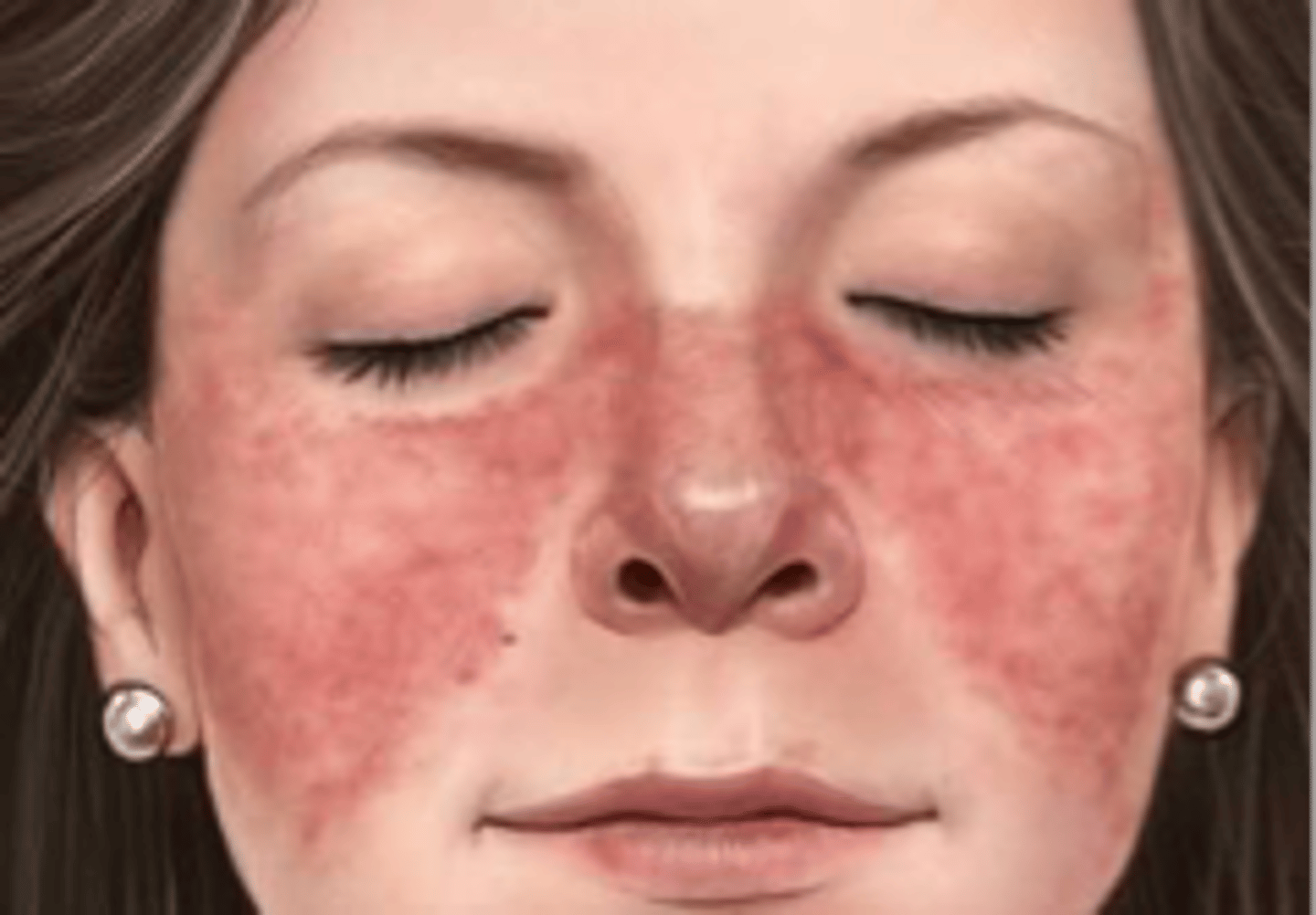 <p>-chronic multisystemic autoimmune disease.</p><p>-can be classified as Discoid Lupus Erythematosus which affects only the skin or SLE which can affect any organ or tissue.</p><p>-as an autoimmune disorder, SLE is characterized by an individual's immune system producing antibodies against its own cells and antigens.</p>