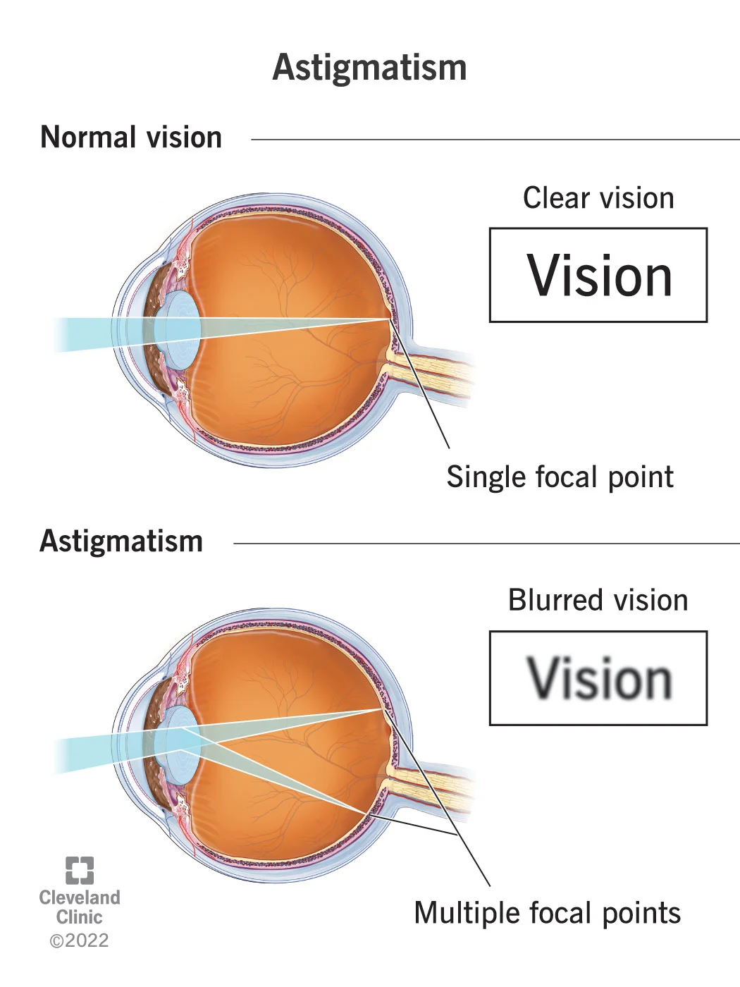 <p>Astigmatism happens when your cornea or lens has a different shape than normal. The shape makes light bend differently as it enters your eye, causing many refractive errors. Thus resulting in blurry vision</p>