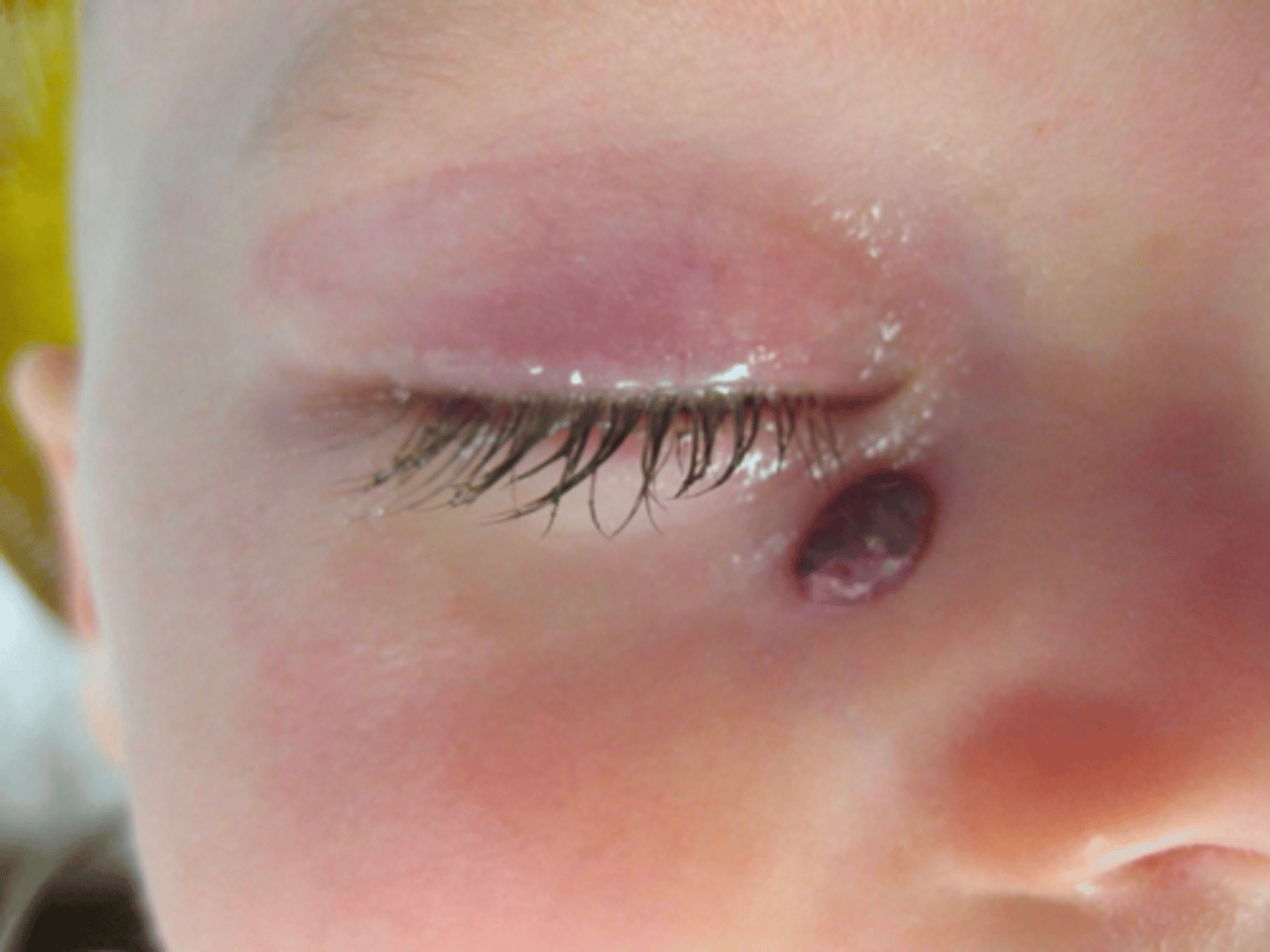 <p>1 year old female patient presents with purple nodule on the surface of the skin lateral to the nose. Her parents noted that it came out of nowhere when she was about 4 weeks old and grew very fast, but has since started to shrink. What is the diagnosis?</p>